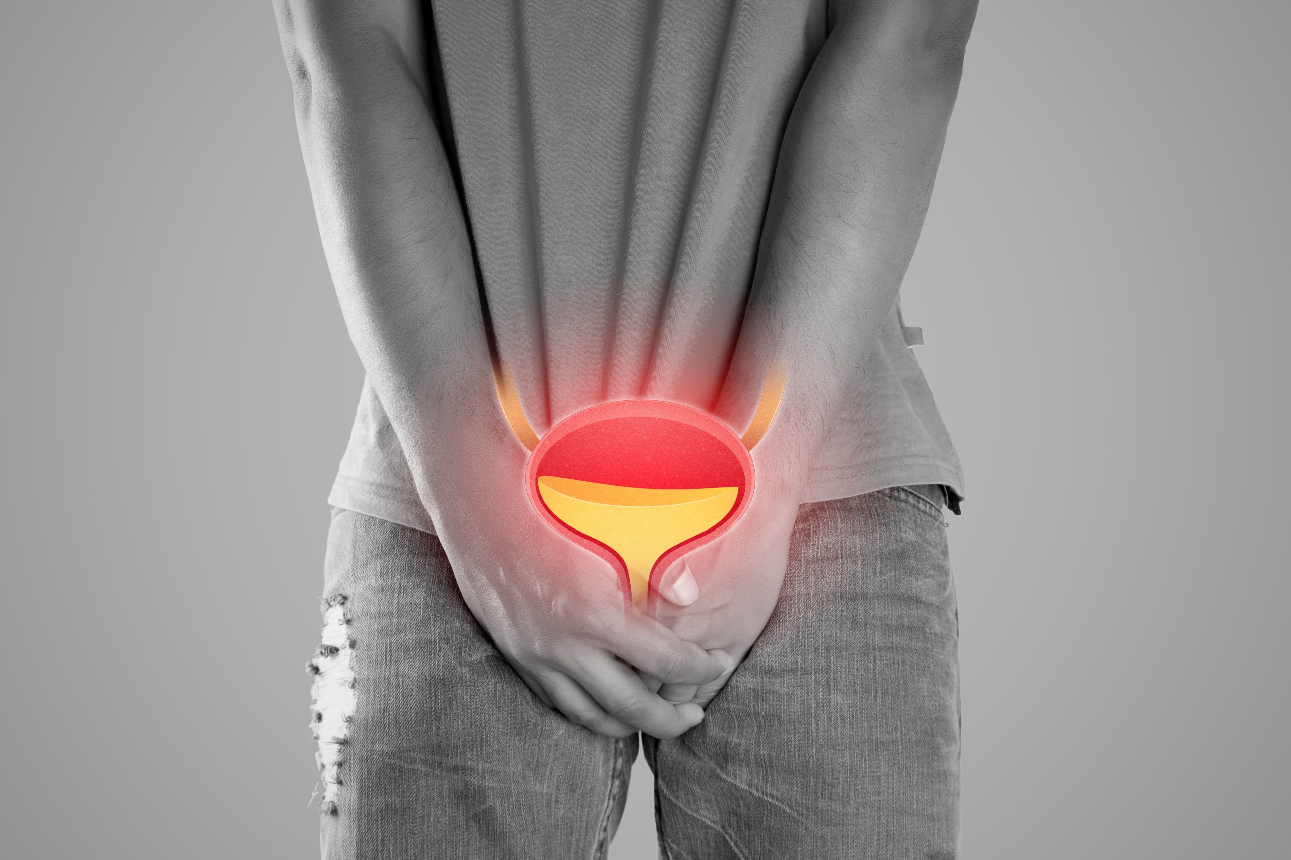 Cistite Intersticial e ITUs em Salvador, BA - Dr. Roberto Rossi